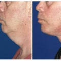 SMAS Facelift In NYC: A Self-Improvement Journey For Personal Development For Mental Health