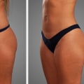 How Can A Fat Transfer Specialist Boost Confidence And Support Personal Development For Mental Health In Scottsdale, AZ?
