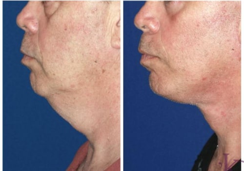 SMAS Facelift In NYC: A Self-Improvement Journey For Personal Development For Mental Health